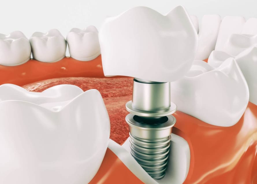 Studio Dentistico Labaro | Implantologia
