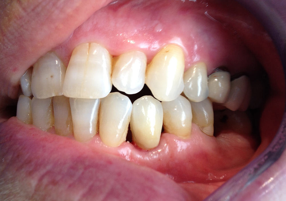 Studio Dentistico Labaro | Caso carico immediato