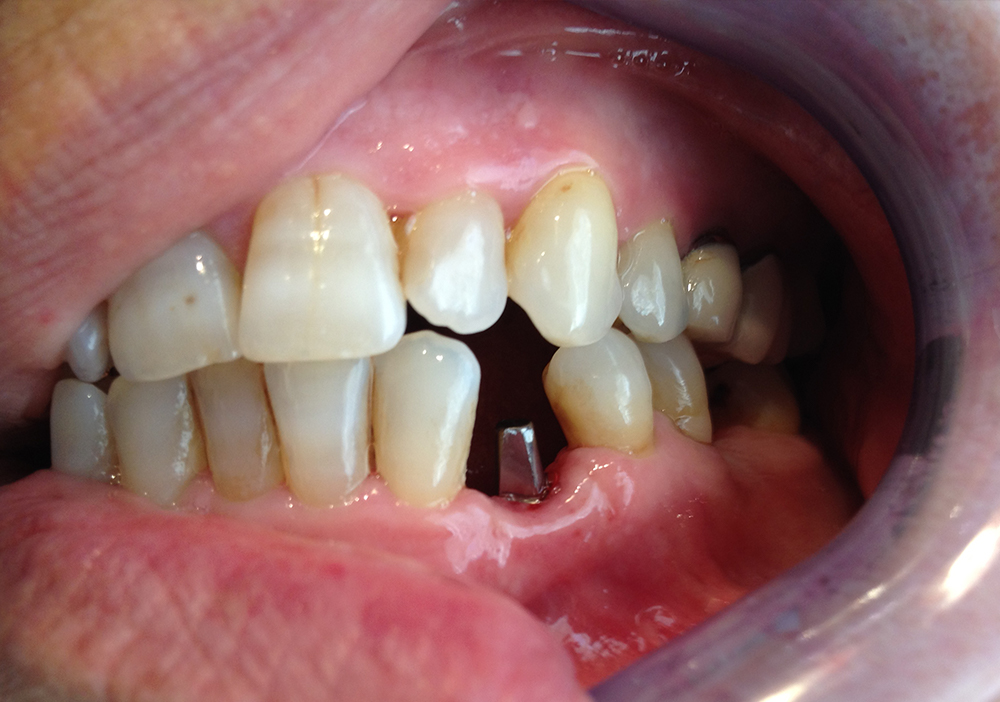 Studio Dentistico Labaro | Caso carico immediato prima