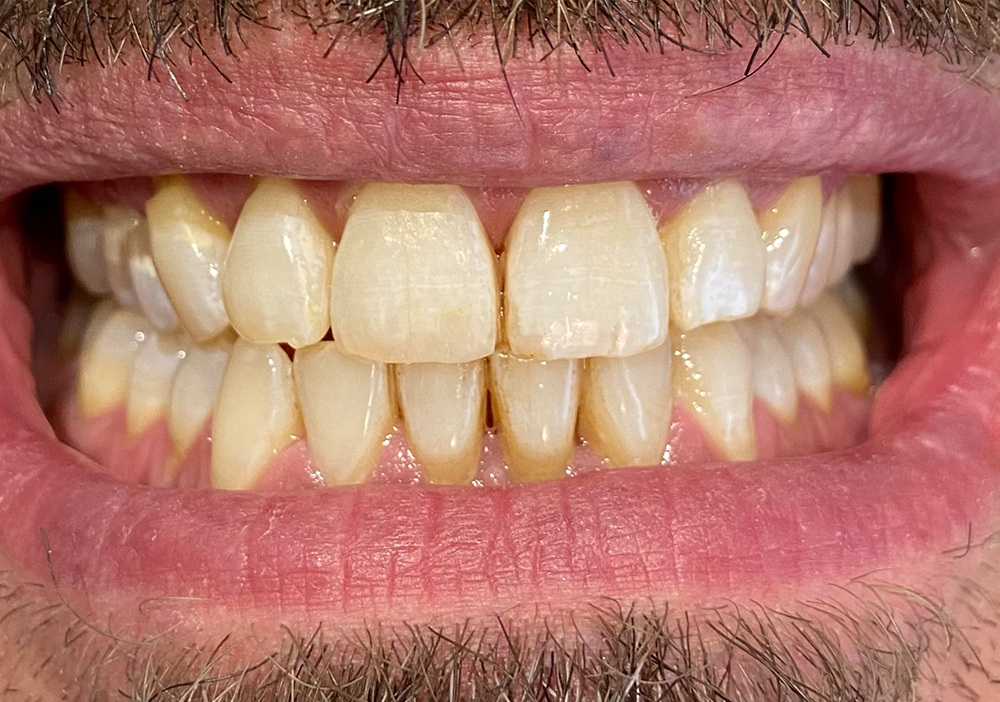Studio Dentistico Labaro | Caso Ricostruzione Estetica Frontale Dopo