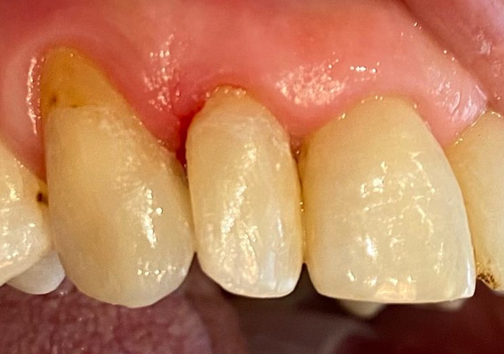 Studio Dentistico Labaro | Caso ricostruzione estetica dopo