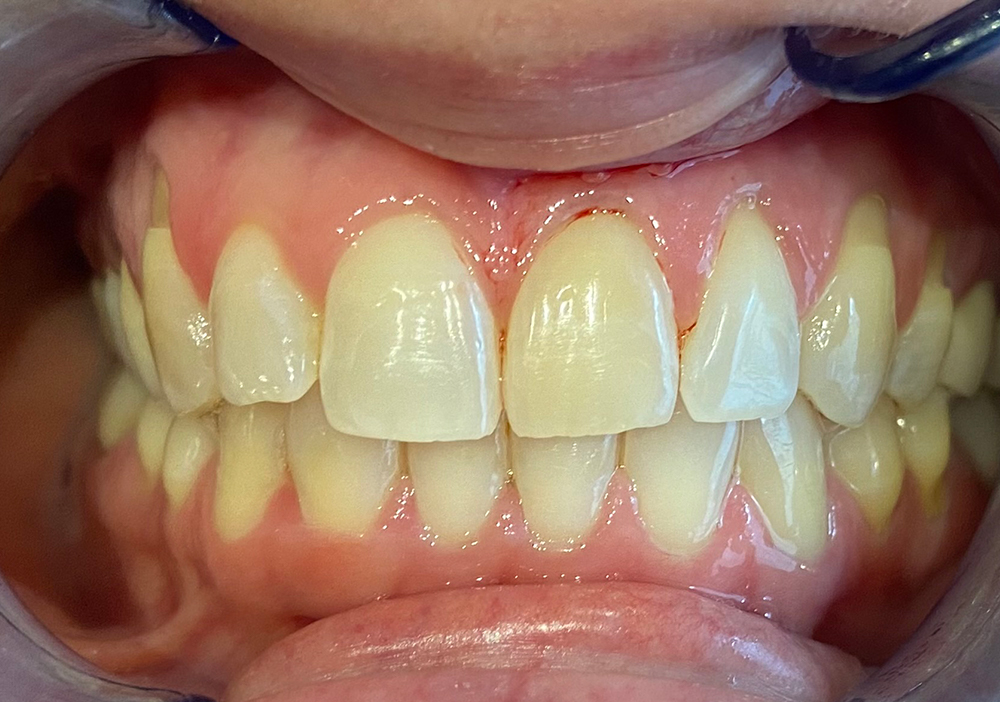 Studio Dentistico Labaro | Caso Sbiancamento Endodontico